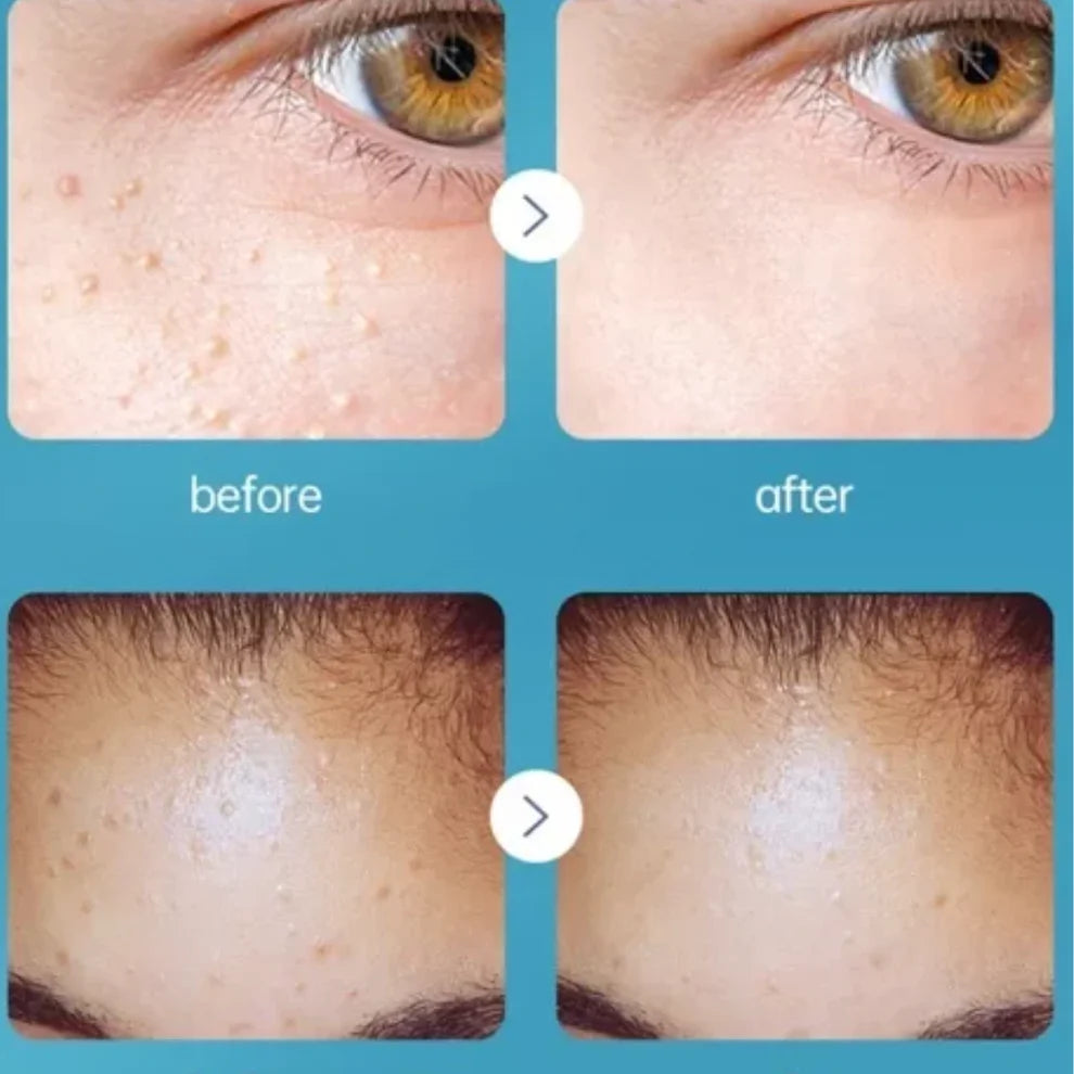 CREMA REMOVEDORA DE VERRUGAS⭐
